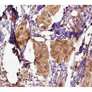 AF0202 at 1/100 staining human breast carcinoma tissue sections by IHC-P. The tissue was formaldehyde fixed and a heat mediated antigen retrieval step in citrate buffer was performed. The tissue was then blocked and incubated with the antibody for 1.5 hours at 22¡ãC. An HRP conjugated goat anti-rabbit antibody was used as the secondary