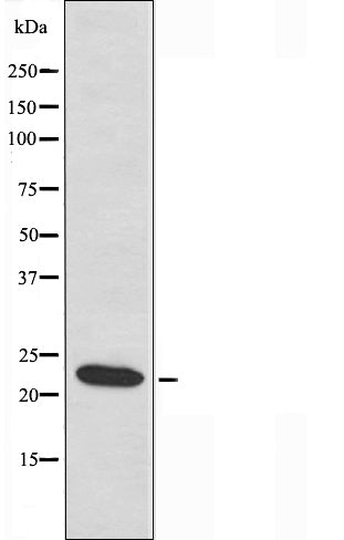 DF3669 at 1/100 staining Human breast cancer tissue by IHC-P. The sample was formaldehyde fixed and a heat mediated antigen retrieval step in citrate buffer was performed. The sample was then blocked and incubated with the antibody for 1.5 hours at 22¡ãC. An HRP conjugated goat anti-rabbit antibody was used as the secondary