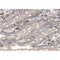 AF0203 at 1/100 staining human colon carcinoma tissue sections by IHC-P. The tissue was formaldehyde fixed and a heat mediated antigen retrieval step in citrate buffer was performed. The tissue was then blocked and incubated with the antibody for 1.5 hours at 22¡ãC. An HRP conjugated goat anti-rabbit antibody was used as the secondary