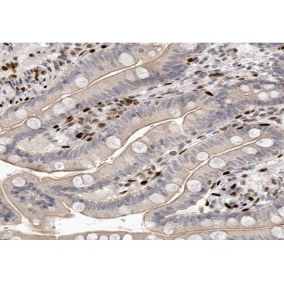 AF0203 at 1/100 staining human colon carcinoma tissue sections by IHC-P. The tissue was formaldehyde fixed and a heat mediated antigen retrieval step in citrate buffer was performed. The tissue was then blocked and incubated with the antibody for 1.5 hours at 22¡ãC. An HRP conjugated goat anti-rabbit antibody was used as the secondary