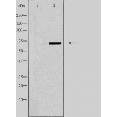 DF3814 at 1/100 staining Human breast cancer tissue by IHC-P. The sample was formaldehyde fixed and a heat mediated antigen retrieval step in citrate buffer was performed. The sample was then blocked and incubated with the antibody for 1.5 hours at 22¡ãC. An HRP conjugated goat anti-rabbit antibody was used as the secondary