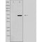 DF3814 at 1/100 staining Human breast cancer tissue by IHC-P. The sample was formaldehyde fixed and a heat mediated antigen retrieval step in citrate buffer was performed. The sample was then blocked and incubated with the antibody for 1.5 hours at 22¡ãC. An HRP conjugated goat anti-rabbit antibody was used as the secondary