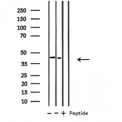 DF3839 at 1/100 staining Human urothelial cancer tissue by IHC-P. The sample was formaldehyde fixed and a heat mediated antigen retrieval step in citrate buffer was performed. The sample was then blocked and incubated with the antibody for 1.5 hours at 22¡ãC. An HRP conjugated goat anti-rabbit antibody was used as the secondary