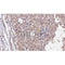 AF0204 at 1/100 staining Human Melanoma tissue by IHC-P. The sample was formaldehyde fixed and a heat mediated antigen retrieval step in citrate buffer was performed. The sample was then blocked and incubated with the antibody for 1.5 hours at 22¡ãC. An HRP conjugated goat anti-rabbit antibody was used as the secondary