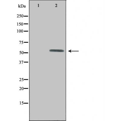 DF4602 at 1/100 staining Human Melanoma tissue by IHC-P. The sample was formaldehyde fixed and a heat mediated antigen retrieval step in citrate buffer was performed. The sample was then blocked and incubated with the antibody for 1.5 hours at 22¡ãC. An HRP conjugated goat anti-rabbit antibody was used as the secondary