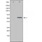 DF4602 at 1/100 staining Human Melanoma tissue by IHC-P. The sample was formaldehyde fixed and a heat mediated antigen retrieval step in citrate buffer was performed. The sample was then blocked and incubated with the antibody for 1.5 hours at 22¡ãC. An HRP conjugated goat anti-rabbit antibody was used as the secondary