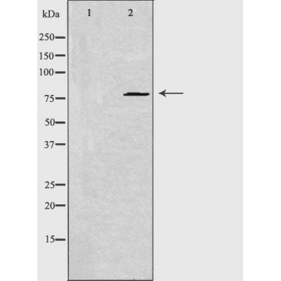 DF4690 at 1/100 staining Human brain cancer tissue by IHC-P. The sample was formaldehyde fixed and a heat mediated antigen retrieval step in citrate buffer was performed. The sample was then blocked and incubated with the antibody for 1.5 hours at 22¡ãC. An HRP conjugated goat anti-rabbit antibody was used as the secondary