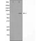 DF4809 at 1/100 staining Human breast cancer tissue by IHC-P. The sample was formaldehyde fixed and a heat mediated antigen retrieval step in citrate buffer was performed. The sample was then blocked and incubated with the antibody for 1.5 hours at 22¡ãC. An HRP conjugated goat anti-rabbit antibody was used as the secondary