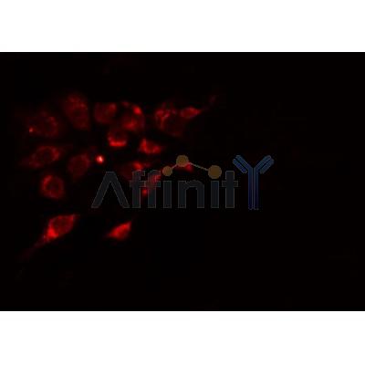 DF4850 at 1/100 staining Human urothelial cancer tissue by IHC-P. The sample was formaldehyde fixed and a heat mediated antigen retrieval step in citrate buffer was performed. The sample was then blocked and incubated with the antibody for 1.5 hours at 22¡ãC. An HRP conjugated goat anti-rabbit antibody was used as the secondary