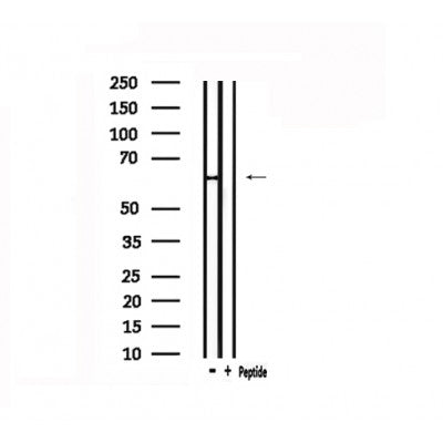 DF4913 at 1/100 staining Human liver cancer tissue by IHC-P. The sample was formaldehyde fixed and a heat mediated antigen retrieval step in citrate buffer was performed. The sample was then blocked and incubated with the antibody for 1.5 hours at 22¡ãC. An HRP conjugated goat anti-rabbit antibody was used as the secondary