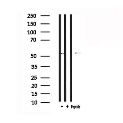 DF4926 at 1/100 staining Human liver cancer tissue by IHC-P. The sample was formaldehyde fixed and a heat mediated antigen retrieval step in citrate buffer was performed. The sample was then blocked and incubated with the antibody for 1.5 hours at 22¡ãC. An HRP conjugated goat anti-rabbit antibody was used as the secondary