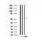 DF4926 at 1/100 staining Human liver cancer tissue by IHC-P. The sample was formaldehyde fixed and a heat mediated antigen retrieval step in citrate buffer was performed. The sample was then blocked and incubated with the antibody for 1.5 hours at 22¡ãC. An HRP conjugated goat anti-rabbit antibody was used as the secondary