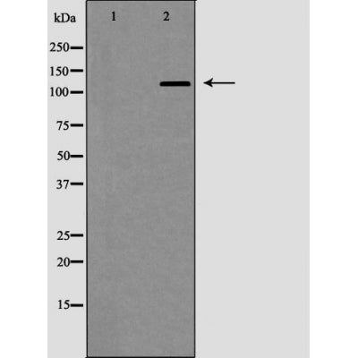 AF5148 at 1/100 staining Human urothelial cancer tissue by IHC-P. The sample was formaldehyde fixed and a heat mediated antigen retrieval step in citrate buffer was performed. The sample was then blocked and incubated with the antibody for 1.5 hours at 22¡ãC. An HRP conjugated goat anti-rabbit antibody was used as the secondary