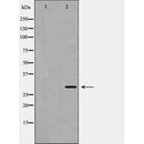 AF5326 at 1/100 staining Human breast cancer tissue by IHC-P. The sample was formaldehyde fixed and a heat mediated antigen retrieval step in citrate buffer was performed. The sample was then blocked and incubated with the antibody for 1.5 hours at 22¡ãC. An HRP conjugated goat anti-rabbit antibody was used as the secondary