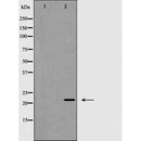 AF5350 at 1/100 staining Human urothelial cancer tissue by IHC-P. The sample was formaldehyde fixed and a heat mediated antigen retrieval step in citrate buffer was performed. The sample was then blocked and incubated with the antibody for 1.5 hours at 22¡ãC. An HRP conjugated goat anti-rabbit antibody was used as the secondary