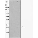AF5364 at 1/100 staining Human urothelial cancer tissue by IHC-P. The sample was formaldehyde fixed and a heat mediated antigen retrieval step in citrate buffer was performed. The sample was then blocked and incubated with the antibody for 1.5 hours at 22¡ãC. An HRP conjugated goat anti-rabbit antibody was used as the secondary