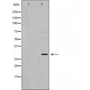 AF5401 at 1/100 staining Human breast cancer tissue by IHC-P. The sample was formaldehyde fixed and a heat mediated antigen retrieval step in citrate buffer was performed. The sample was then blocked and incubated with the antibody for 1.5 hours at 22¡ãC. An HRP conjugated goat anti-rabbit antibody was used as the secondary