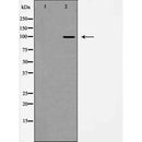 AF5458 at 1/100 staining Human liver cancer tissue by IHC-P. The sample was formaldehyde fixed and a heat mediated antigen retrieval step in citrate buffer was performed. The sample was then blocked and incubated with the antibody for 1.5 hours at 22¡ãC. An HRP conjugated goat anti-rabbit antibody was used as the secondary