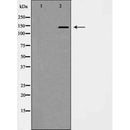 AF5489 at 1/100 staining Human liver cancer tissue by IHC-P. The sample was formaldehyde fixed and a heat mediated antigen retrieval step in citrate buffer was performed. The sample was then blocked and incubated with the antibody for 1.5 hours at 22¡ãC. An HRP conjugated goat anti-rabbit antibody was used as the secondary