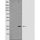 AF5490 at 1/100 staining Human brain cancer tissue by IHC-P. The sample was formaldehyde fixed and a heat mediated antigen retrieval step in citrate buffer was performed. The sample was then blocked and incubated with the antibody for 1.5 hours at 22¡ãC. An HRP conjugated goat anti-rabbit antibody was used as the secondary