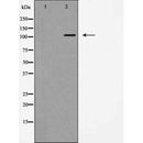 AF5496 at 1/100 staining Human breast cancer tissue by IHC-P. The sample was formaldehyde fixed and a heat mediated antigen retrieval step in citrate buffer was performed. The sample was then blocked and incubated with the antibody for 1.5 hours at 22¡ãC. An HRP conjugated goat anti-rabbit antibody was used as the secondary