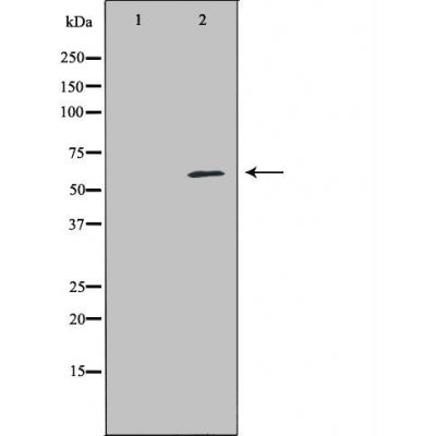 DF6004 at 1/100 staining Human urothelial cancer tissue by IHC-P. The sample was formaldehyde fixed and a heat mediated antigen retrieval step in citrate buffer was performed. The sample was then blocked and incubated with the antibody for 1.5 hours at 22¡ãC. An HRP conjugated goat anti-rabbit antibody was used as the secondary