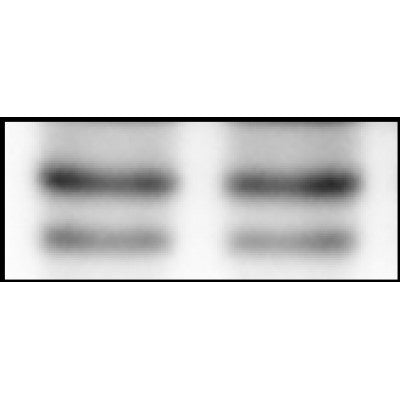 DF6010 at 1/100 staining Human breast cancer tissue by IHC-P. The sample was formaldehyde fixed and a heat mediated antigen retrieval step in citrate buffer was performed. The sample was then blocked and incubated with the antibody for 1.5 hours at 22¡ãC. An HRP conjugated goat anti-rabbit antibody was used as the secondary