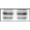 DF6010 at 1/100 staining Human breast cancer tissue by IHC-P. The sample was formaldehyde fixed and a heat mediated antigen retrieval step in citrate buffer was performed. The sample was then blocked and incubated with the antibody for 1.5 hours at 22¡ãC. An HRP conjugated goat anti-rabbit antibody was used as the secondary
