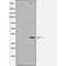 DF6024 at 1/100 staining Human breast cancer tissue by IHC-P. The sample was formaldehyde fixed and a heat mediated antigen retrieval step in citrate buffer was performed. The sample was then blocked and incubated with the antibody for 1.5 hours at 22¡ãC. An HRP conjugated goat anti-rabbit antibody was used as the secondary