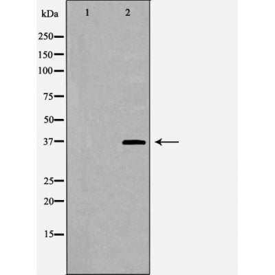 DF6029 at 1/100 staining Human brain cancer tissue by IHC-P. The sample was formaldehyde fixed and a heat mediated antigen retrieval step in citrate buffer was performed. The sample was then blocked and incubated with the antibody for 1.5 hours at 22¡ãC. An HRP conjugated goat anti-rabbit antibody was used as the secondary