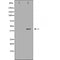 DF6050 at 1/100 staining Human urothelial cancer tissue by IHC-P. The sample was formaldehyde fixed and a heat mediated antigen retrieval step in citrate buffer was performed. The sample was then blocked and incubated with the antibody for 1.5 hours at 22¡ãC. An HRP conjugated goat anti-rabbit antibody was used as the secondary