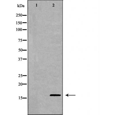 DF6054 at 1/100 staining Human Melanoma tissue by IHC-P. The sample was formaldehyde fixed and a heat mediated antigen retrieval step in citrate buffer was performed. The sample was then blocked and incubated with the antibody for 1.5 hours at 22¡ãC. An HRP conjugated goat anti-rabbit antibody was used as the secondary