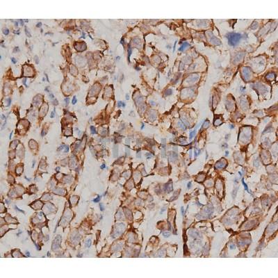 DF6087 staining HepG2 by IF/ICC. The sample were fixed with PFA and permeabilized in 0.1% Triton X-100,then blocked in 10% serum for 45 minutes at 25¡ãC. The primary antibody was diluted at 1/200 and incubated with the sample for 1 hour at 37¡ãC. An  Alexa Fluor 594 conjugated goat anti-rabbit IgG (H+L) Ab, diluted at 1/600, was used as the secondary antibod