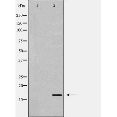 DF6099 at 1/100 staining Human urothelial cancer tissue by IHC-P. The sample was formaldehyde fixed and a heat mediated antigen retrieval step in citrate buffer was performed. The sample was then blocked and incubated with the antibody for 1.5 hours at 22¡ãC. An HRP conjugated goat anti-rabbit antibody was used as the secondary