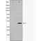 DF6102 at 1/200 staining human Breast cancer tissue sections by IHC-P. The tissue was formaldehyde fixed and a heat mediated antigen retrieval step in citrate buffer was performed. The tissue was then blocked and incubated with the antibody for 1.5 hours at 22¡ãC. An HRP conjugated goat anti-rabbit antibody was used as the secondary