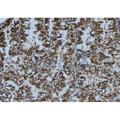 Western blot analysis of extracts from various samples, using DDX58  Antibody.
 Lane 1: Hela treated with blocking peptide;
 Lane 2: Hela;
 Lane 3: HepG2.