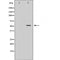 DF6118 at 1/100 staining Human brain cancer tissue by IHC-P. The sample was formaldehyde fixed and a heat mediated antigen retrieval step in citrate buffer was performed. The sample was then blocked and incubated with the antibody for 1.5 hours at 22¡ãC. An HRP conjugated goat anti-rabbit antibody was used as the secondary