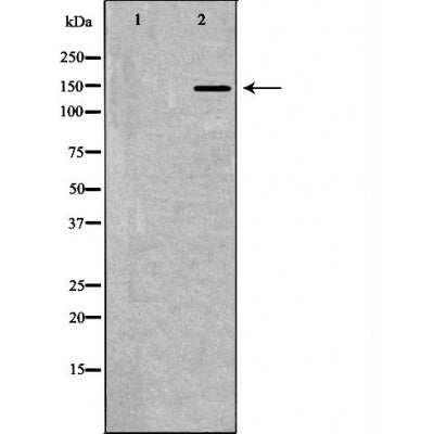DF6144 at 1/100 staining Human urothelial cancer tissue by IHC-P. The sample was formaldehyde fixed and a heat mediated antigen retrieval step in citrate buffer was performed. The sample was then blocked and incubated with the antibody for 1.5 hours at 22¡ãC. An HRP conjugated goat anti-rabbit antibody was used as the secondary