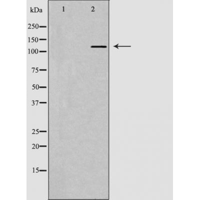 DF6164 at 1/100 staining Human breast cancer tissue by IHC-P. The sample was formaldehyde fixed and a heat mediated antigen retrieval step in citrate buffer was performed. The sample was then blocked and incubated with the antibody for 1.5 hours at 22¡ãC. An HRP conjugated goat anti-rabbit antibody was used as the secondary