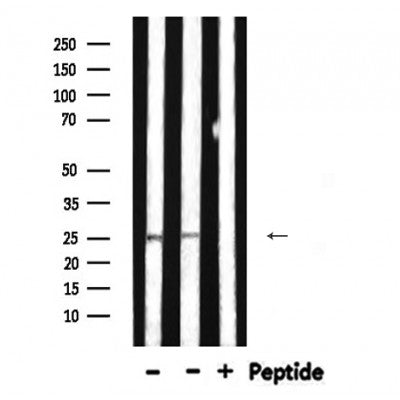 DF6168 at 1/100 staining Human liver cancer tissue by IHC-P. The sample was formaldehyde fixed and a heat mediated antigen retrieval step in citrate buffer was performed. The sample was then blocked and incubated with the antibody for 1.5 hours at 22¡ãC. An HRP conjugated goat anti-rabbit antibody was used as the secondary