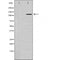 DF6173 at 1/100 staining Human brain cancer tissue by IHC-P. The sample was formaldehyde fixed and a heat mediated antigen retrieval step in citrate buffer was performed. The sample was then blocked and incubated with the antibody for 1.5 hours at 22¡ãC. An HRP conjugated goat anti-rabbit antibody was used as the secondary