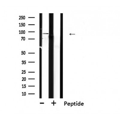 DF6179 at 1/100 staining Human breast cancer tissue by IHC-P. The sample was formaldehyde fixed and a heat mediated antigen retrieval step in citrate buffer was performed. The sample was then blocked and incubated with the antibody for 1.5 hours at 22¡ãC. An HRP conjugated goat anti-rabbit antibody was used as the secondary
