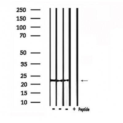 DF6207 at 1/100 staining Human liver cancer tissue by IHC-P. The sample was formaldehyde fixed and a heat mediated antigen retrieval step in citrate buffer was performed. The sample was then blocked and incubated with the antibody for 1.5 hours at 22¡ãC. An HRP conjugated goat anti-rabbit antibody was used as the secondary