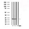 DF6207 at 1/100 staining Human liver cancer tissue by IHC-P. The sample was formaldehyde fixed and a heat mediated antigen retrieval step in citrate buffer was performed. The sample was then blocked and incubated with the antibody for 1.5 hours at 22¡ãC. An HRP conjugated goat anti-rabbit antibody was used as the secondary