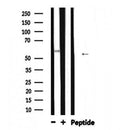 DF6225 at 1/100 staining Human liver cancer tissue by IHC-P. The sample was formaldehyde fixed and a heat mediated antigen retrieval step in citrate buffer was performed. The sample was then blocked and incubated with the antibody for 1.5 hours at 22¡ãC. An HRP conjugated goat anti-rabbit antibody was used as the secondary