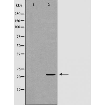 DF6226 at 1/100 staining Human Melanoma tissue by IHC-P. The sample was formaldehyde fixed and a heat mediated antigen retrieval step in citrate buffer was performed. The sample was then blocked and incubated with the antibody for 1.5 hours at 22¡ãC. An HRP conjugated goat anti-rabbit antibody was used as the secondary