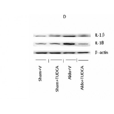 DF6252 at 1/100 staining Human Melanoma tissue by IHC-P. The sample was formaldehyde fixed and a heat mediated antigen retrieval step in citrate buffer was performed. The sample was then blocked and incubated with the antibody for 1.5 hours at 22¡ãC. An HRP conjugated goat anti-rabbit antibody was used as the secondary