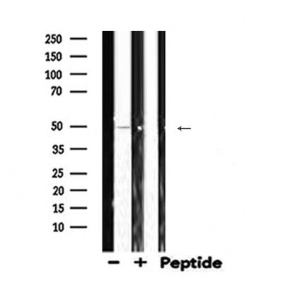 DF6268 at 1/100 staining Human brain cancer tissue by IHC-P. The sample was formaldehyde fixed and a heat mediated antigen retrieval step in citrate buffer was performed. The sample was then blocked and incubated with the antibody for 1.5 hours at 22¡ãC. An HRP conjugated goat anti-rabbit antibody was used as the secondary