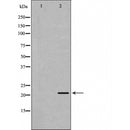 DF6292 at 1/100 staining Human brain cancer tissue by IHC-P. The sample was formaldehyde fixed and a heat mediated antigen retrieval step in citrate buffer was performed. The sample was then blocked and incubated with the antibody for 1.5 hours at 22¡ãC. An HRP conjugated goat anti-rabbit antibody was used as the secondary