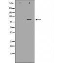 DF6306 at 1/100 staining Human liver cancer tissue by IHC-P. The sample was formaldehyde fixed and a heat mediated antigen retrieval step in citrate buffer was performed. The sample was then blocked and incubated with the antibody for 1.5 hours at 22¡ãC. An HRP conjugated goat anti-rabbit antibody was used as the secondary